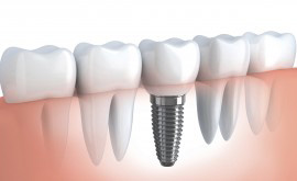 Dental Implants