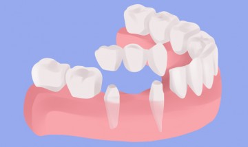 Dental Bridges