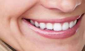 Teeth Whitening